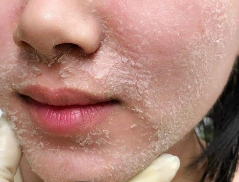 Hướng dẫn chi tiết các bước peel da tại nhà an toàn